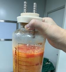 蚌埠水动力吸脂手术要做多久？